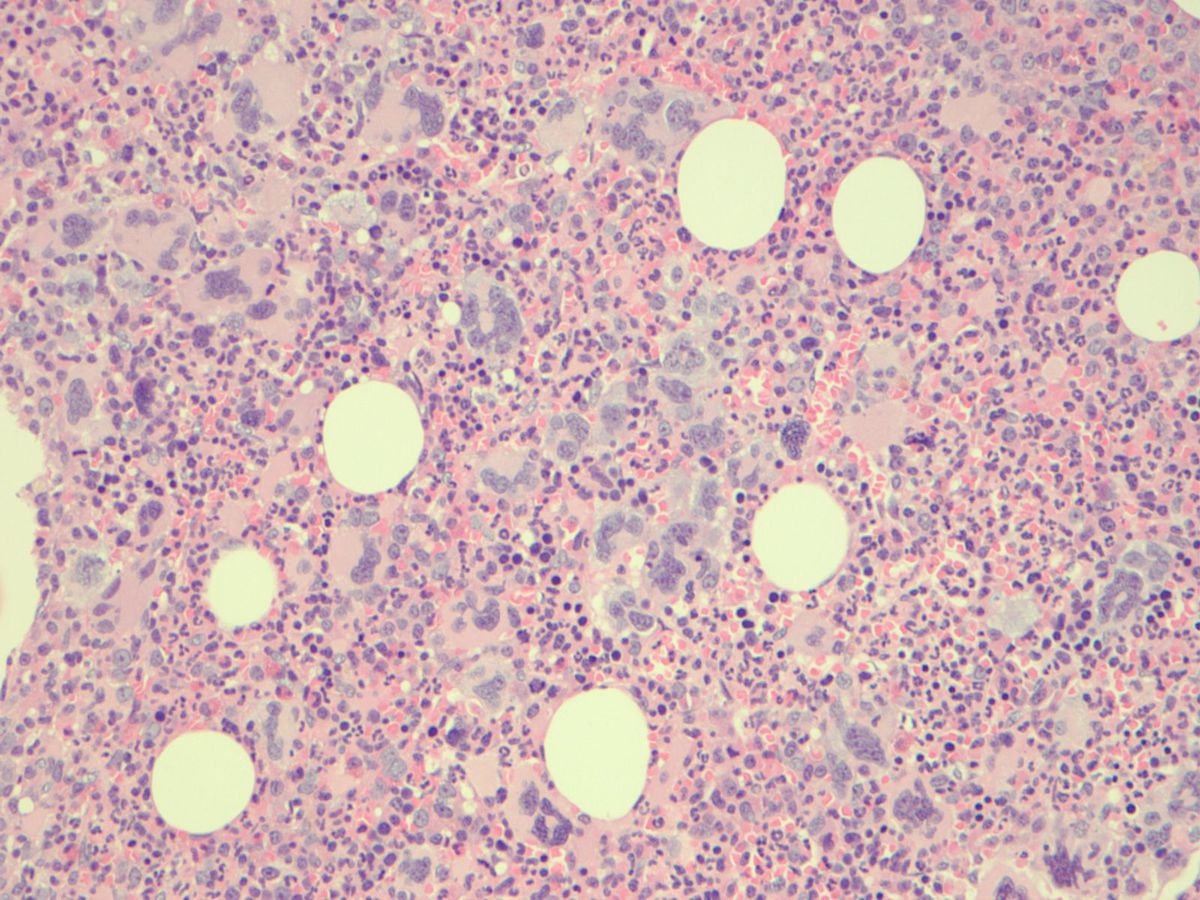 Bone marrow biopsy with essential thrombocythemia (H&E x200)